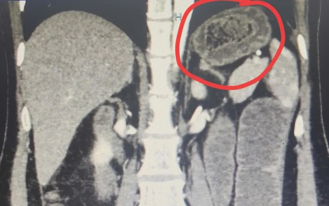 Nguy hiểm: Tắc ruột do b&atilde; thức ăn- Ảnh 1.