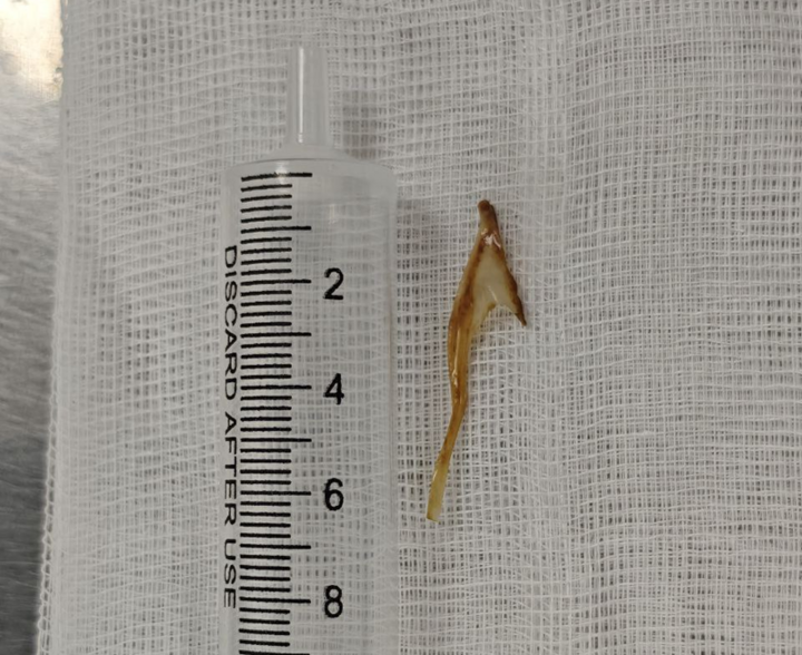 Tưởng bị trĩ h&oacute;a ra xương g&agrave; d&agrave;i 3cm mắc ở hậu m&ocirc;n- Ảnh 1.