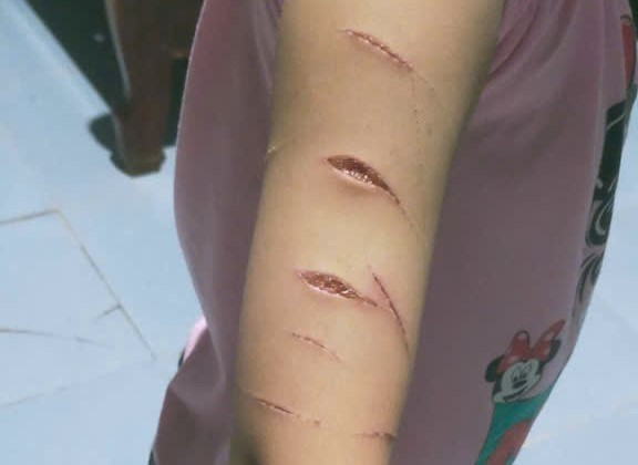 C&ocirc;ng an th&ocirc;ng tin vụ nữ sinh lớp 5 ở C&agrave; Mau bị rạch tay- Ảnh 1.