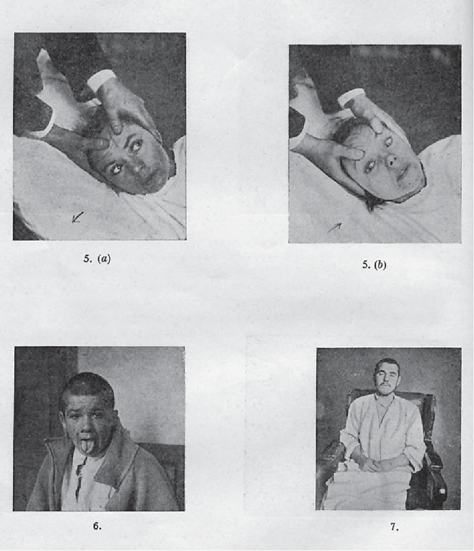 Bí ẩn về căn bệnh cướp đi 500.000 sinh mạng rồi đột ngột biến mất không một dấu vết- Ảnh 2. Bí ẩn về căn bệnh cướp đi 500.000 sinh mạng rồi đột ngột biến mất không một dấu vết- Ảnh 2.