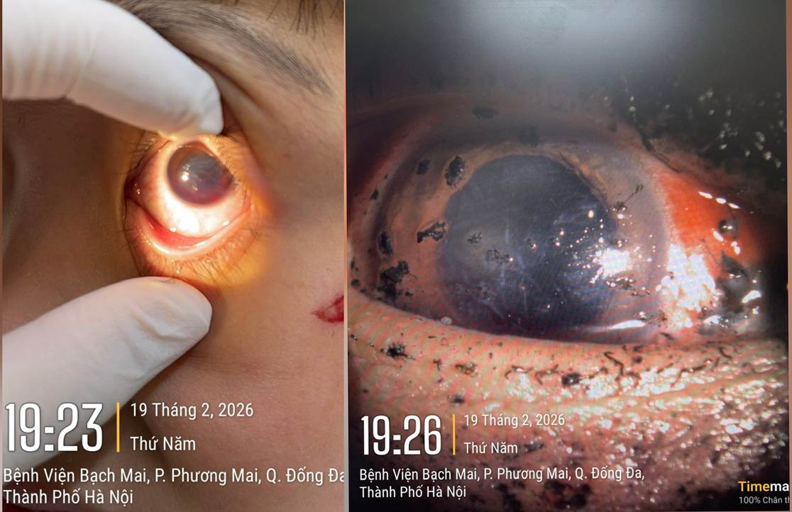 Bệnh viện Bạch Mai cảnh b&aacute;o 1 t&igrave;nh trạng bệnh ở mắt tăng vọt ngay trong 3 ng&agrave;y đầu năm 2026- Ảnh 1.