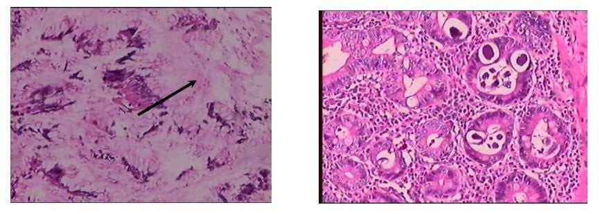 Bệnh viện 115 cảnh b&aacute;o loại giun k&yacute; sinh trong ruột: Kh&ocirc;ng triệu chứng, nhưng g&acirc;y tử vong nếu uống sai thuốc kh&aacute;ng sinh- Ảnh 1.