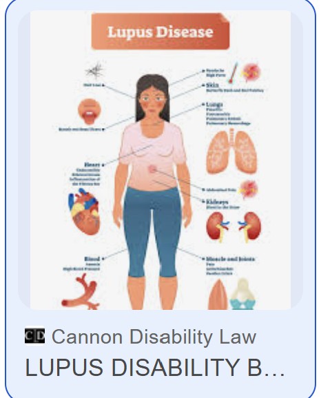 Bệnh nh&acirc;n lupus ban đỏ nhận TIN VUI ngay đầu năm mới- Ảnh 1.