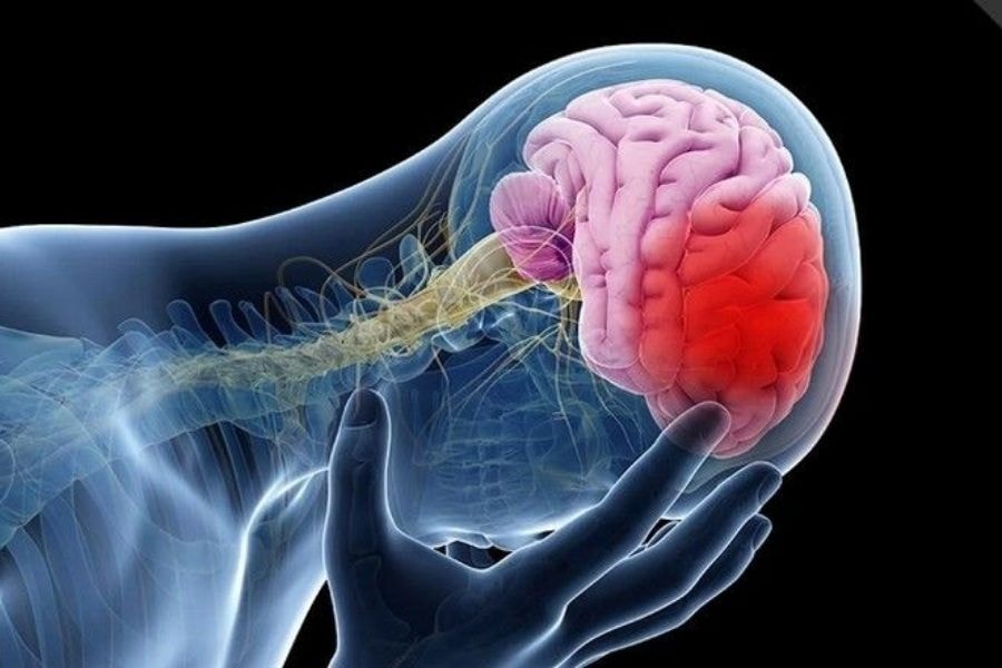 Sau h&oacute;a v&agrave;ng, người đ&agrave;n &ocirc;ng t&ecirc; tay tưởng say rượu n&ecirc;n uống chanh mật ong: S&aacute;ng h&ocirc;m sau b&aacute;c sĩ b&aacute;o ĐỘT QUỴ- Ảnh 3.