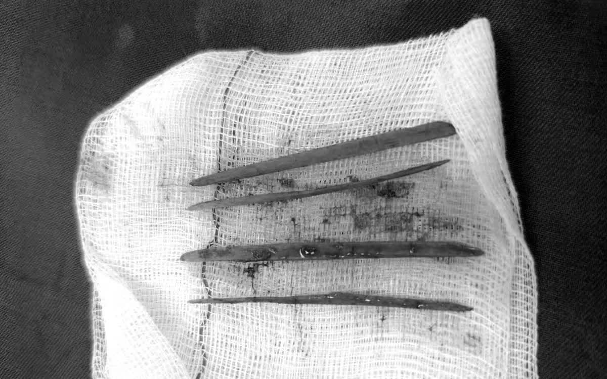 Nuốt 3 c&acirc;y tăm, nữ bệnh nh&acirc;n phải mổ cấp cứu- Ảnh 1.