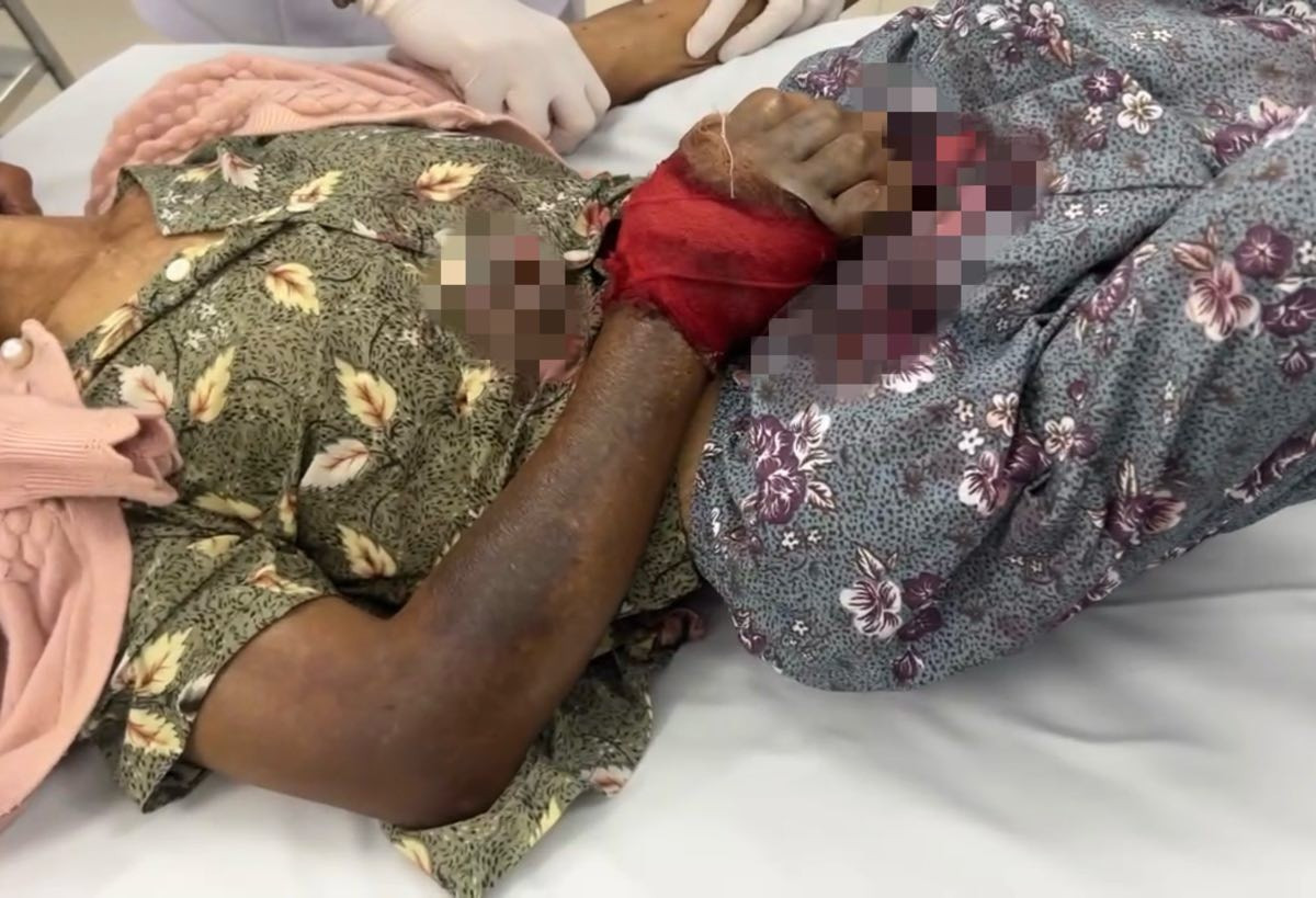 Uống thuốc d&acirc;n gian sau khi bị rắn cắn, cụ b&agrave; 76 tuổi nguy kịch- Ảnh 1.