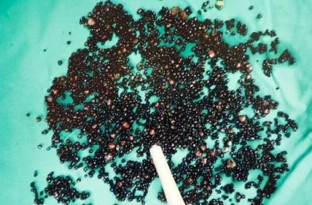 5000 viên sỏi lấp kín túi mật người đàn ông: Bác sĩ nói thẳng: "3 thói quen này là nguyên nhân"- Ảnh 1. 5000 viên sỏi lấp kín túi mật người đàn ông: Bác sĩ nói thẳng: "3 thói quen này là nguyên nhân"- Ảnh 1.