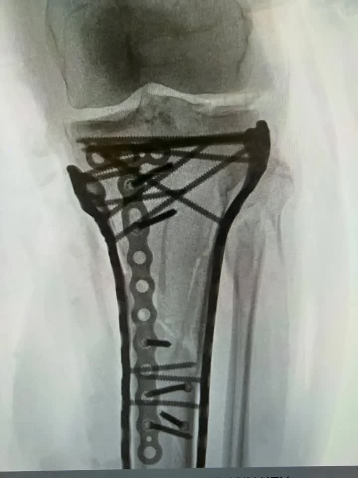 X&uacute;c động lời nhắn Ronaldo gửi nữ thần trượt tuyết su&yacute;t phải cắt cụt ch&acirc;n sau tai nạn kinh ho&agrave;ng ở Olympic- Ảnh 2.