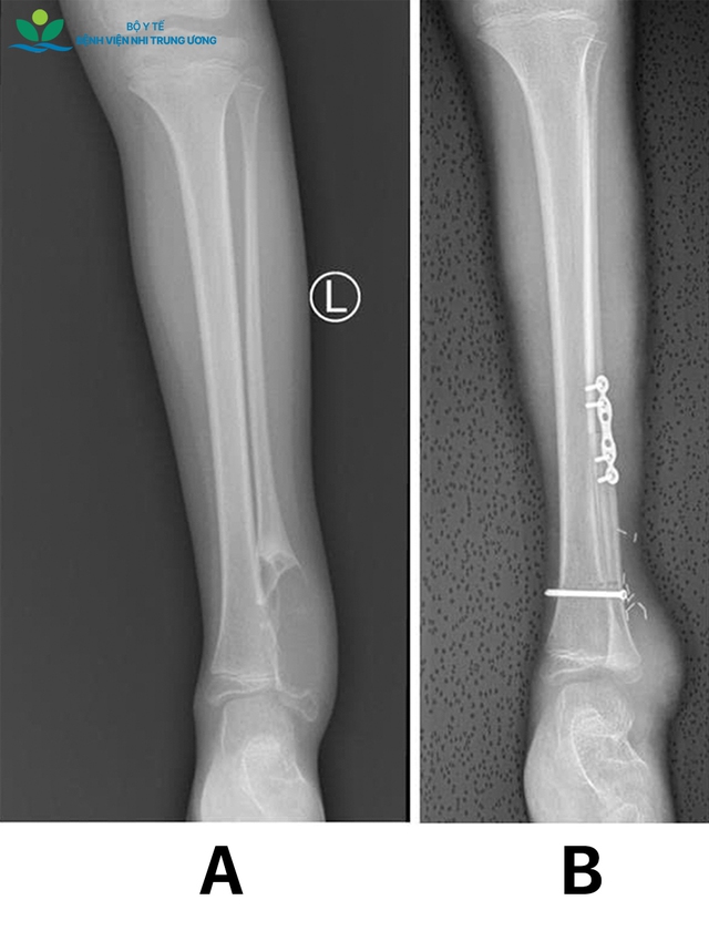 Cứu đ&ocirc;i ch&acirc;n b&eacute; g&aacute;i 8 tuổi khỏi nguy cơ t&agrave;n phế v&igrave; ung thư sụn- Ảnh 4.