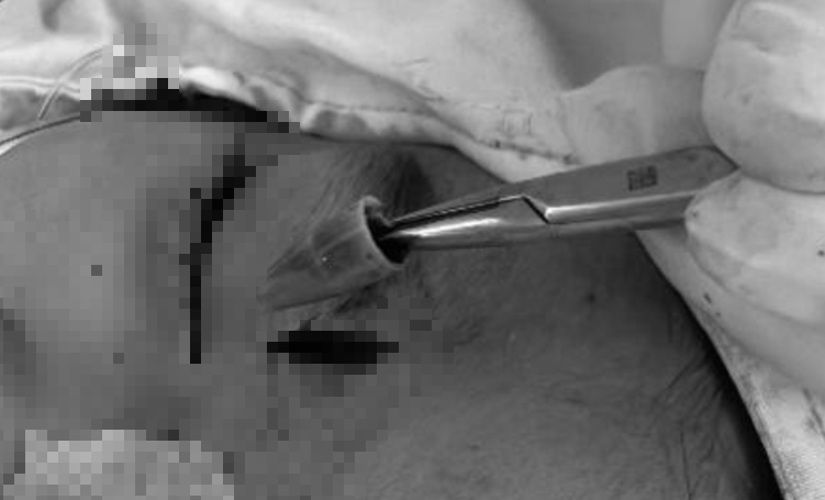 B&eacute; trai đau v&ugrave;ng mắt dữ dội, b&aacute;c sĩ sốc khi ph&aacute;t hiện dị vật "t&agrave;ng h&igrave;nh"- Ảnh 1.