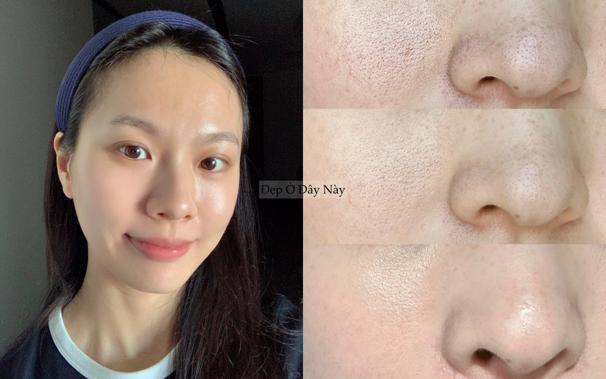 Lỗ ch&acirc;n l&ocirc;ng kh&ocirc;ng biến mất, nhưng t&ocirc;i đ&atilde; khiến ch&uacute;ng "nhỏ lại" thấy r&otilde; nhờ đ&uacute;ng 2 thứ- Ảnh 1.