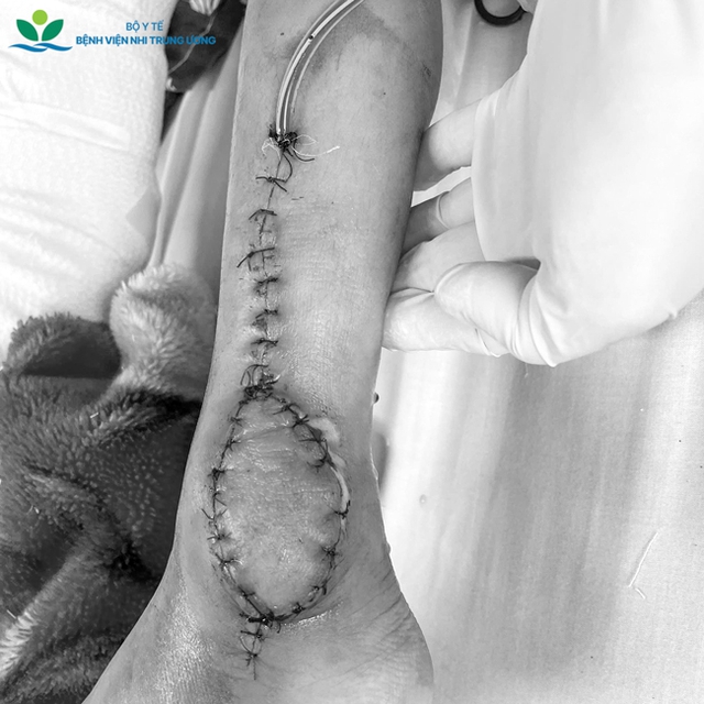 Cứu đ&ocirc;i ch&acirc;n b&eacute; g&aacute;i 8 tuổi khỏi nguy cơ t&agrave;n phế v&igrave; ung thư sụn- Ảnh 5.