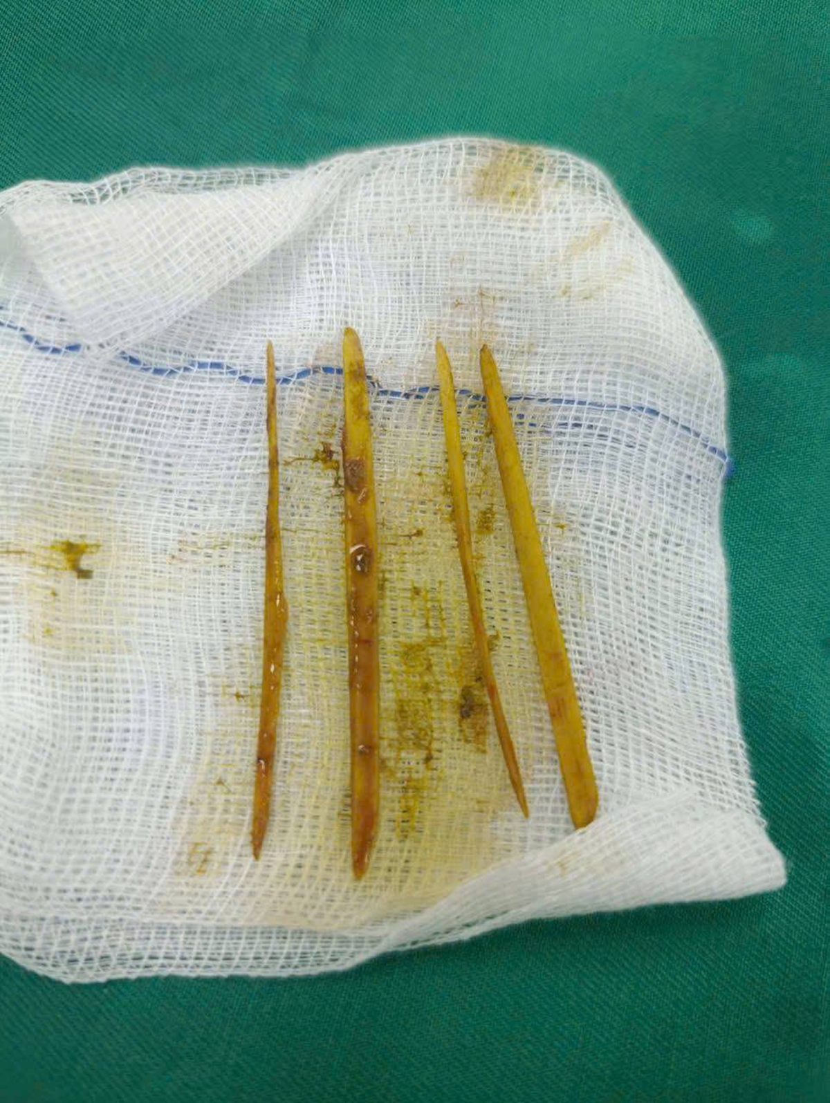 C&ocirc; g&aacute;i 26 tuổi đau bụng dữ dội, b&aacute;c sĩ &ldquo;chết lặng&rdquo; khi ph&aacute;t hiện thứ b&ecirc;n trong- Ảnh 2.