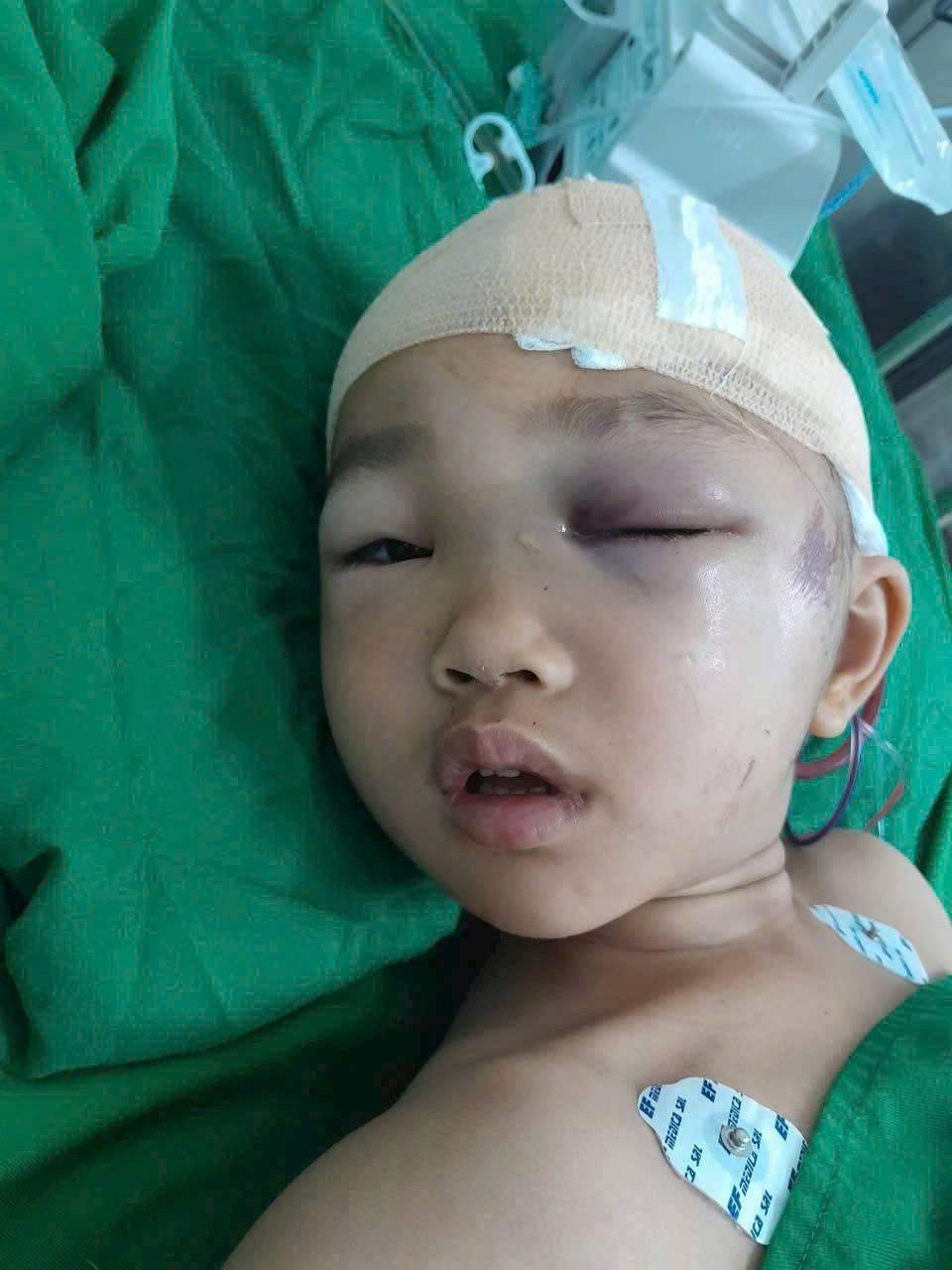 B&eacute; g&aacute;i 6 tuổi nguy kịch sau khi ng&atilde; từ tầng 2 ng&agrave;y m&ugrave;ng 2 Tết, gia đ&igrave;nh ngh&egrave;o kiệt quệ cầu cứu- Ảnh 2.