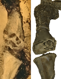 H&eacute; lộ manh mối về nguồn gốc của bệnh u xương- Ảnh 2.