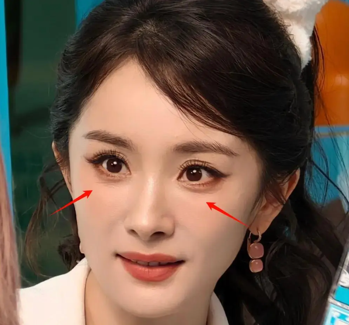 Bị nhăn mắt nhiều th&igrave; n&ecirc;n d&ugrave;ng Hifu hay Thermage?- Ảnh 1.