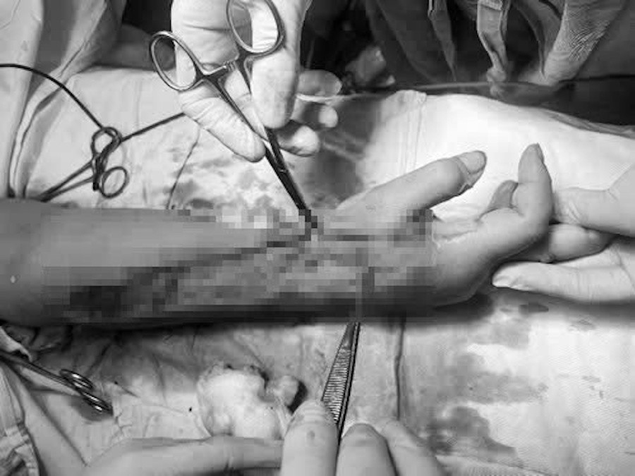 Người phụ nữ c&oacute; nguy cơ bị cụt cẳng tay khi dựng c&acirc;y n&ecirc;u đ&oacute;n Tết- Ảnh 2.