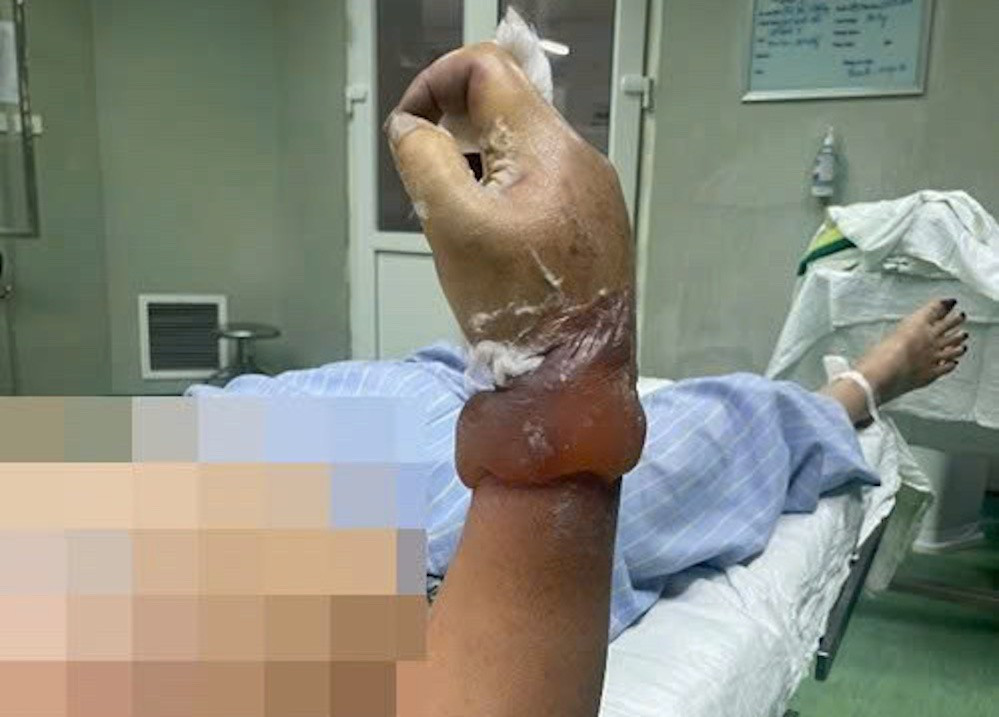 Người phụ nữ c&oacute; nguy cơ bị cụt cẳng tay khi dựng c&acirc;y n&ecirc;u đ&oacute;n Tết- Ảnh 1.