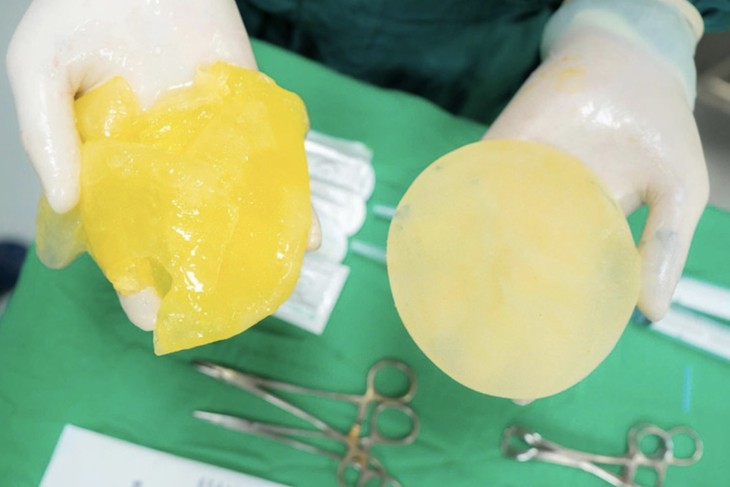 Bác sĩ cảnh báo KHẨN: Người chơi pickleball gặp 5 dấu hiệu này có thể đang vỡ túi ngực- Ảnh 1.