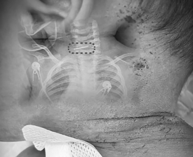 Bé trai bị sốt và co giật, bác sĩ phát hiện ra điều đáng sợ- Ảnh 1.