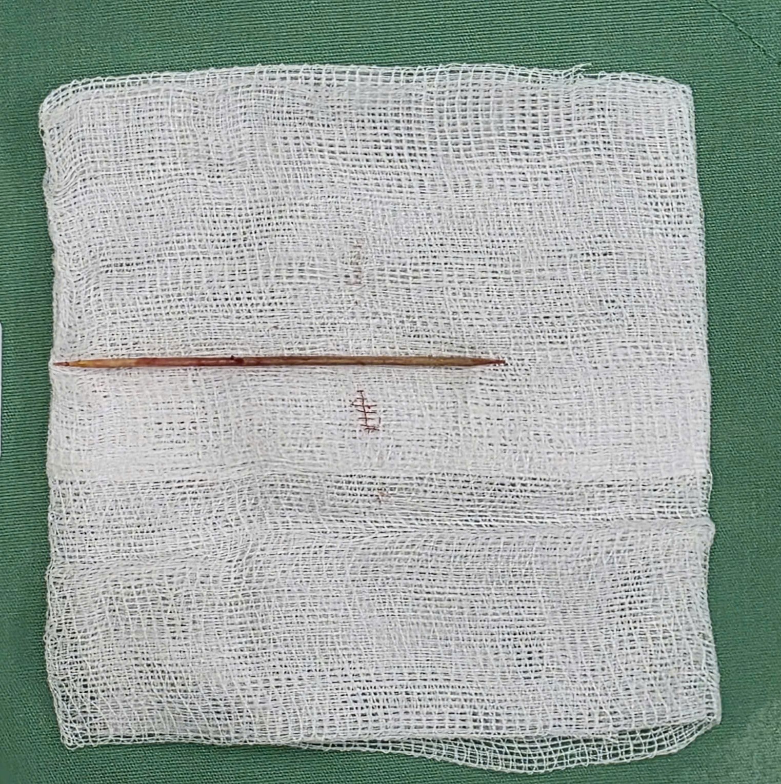 Chỉ v&igrave; một th&oacute;i quen sau bữa ăn, người đ&agrave;n &ocirc;ng nhập viện nguy kịch- Ảnh 2.