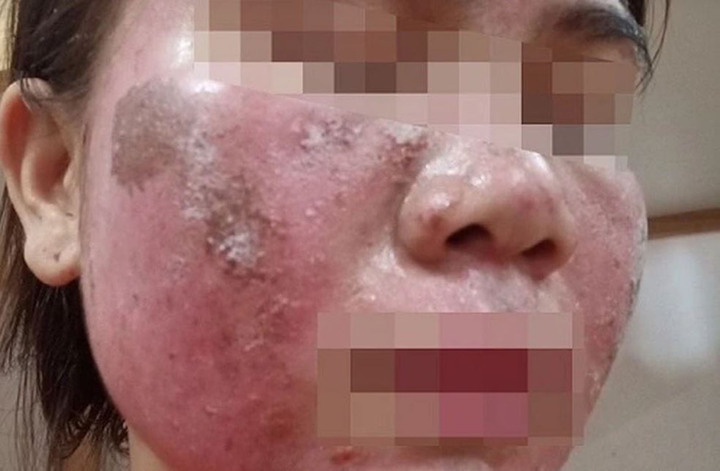 'Vỡ mộng' da đẹp đ&oacute;n Tết: Tan n&aacute;t mặt v&igrave; tự peel da theo hướng dẫn tr&ecirc;n mạng- Ảnh 1.