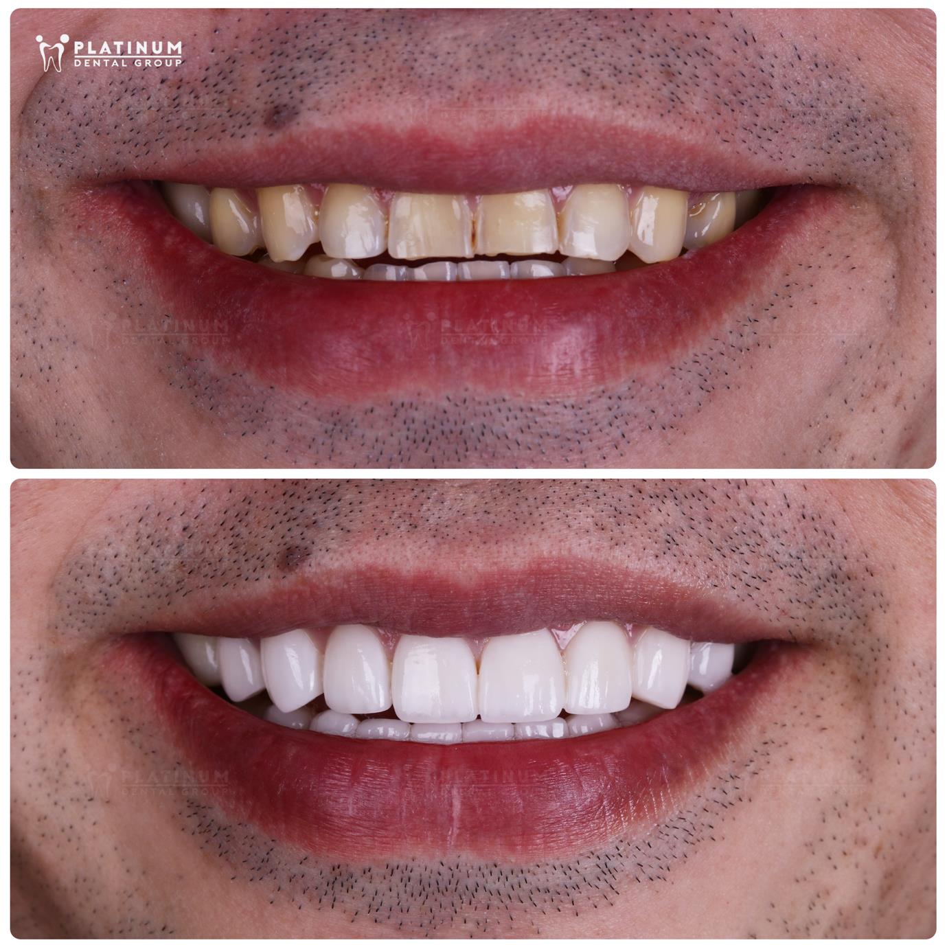 Đừng để nụ cười d&aacute;n sứ Veneer &ldquo;xuống cấp&rdquo;- Ảnh 2.