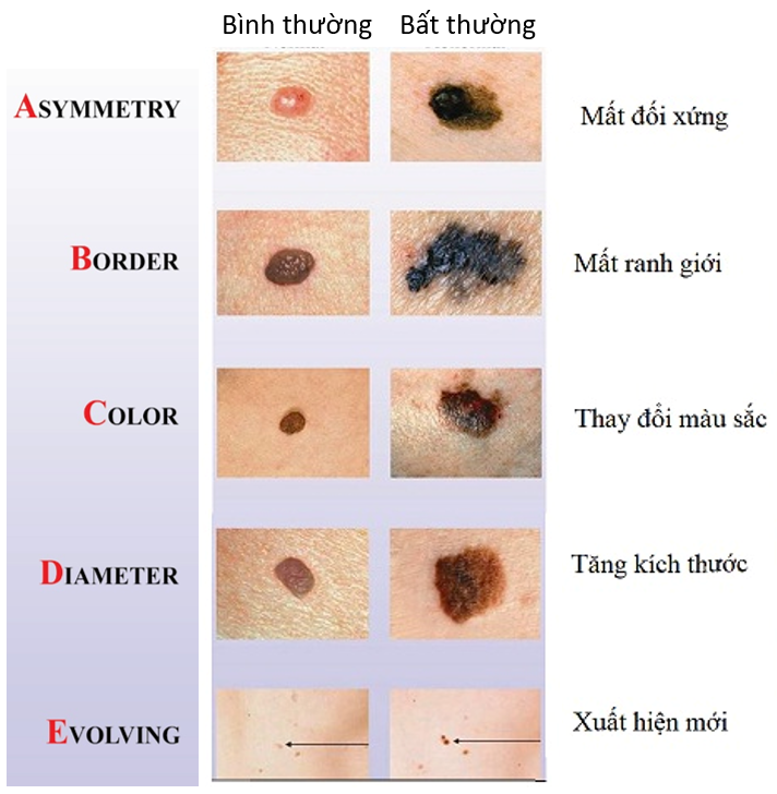 Ung thư da: Nguy hiểm tiềm ẩn từ những tổn thương kh&ocirc;ng đau, kh&ocirc;ng ngứa- Ảnh 1.