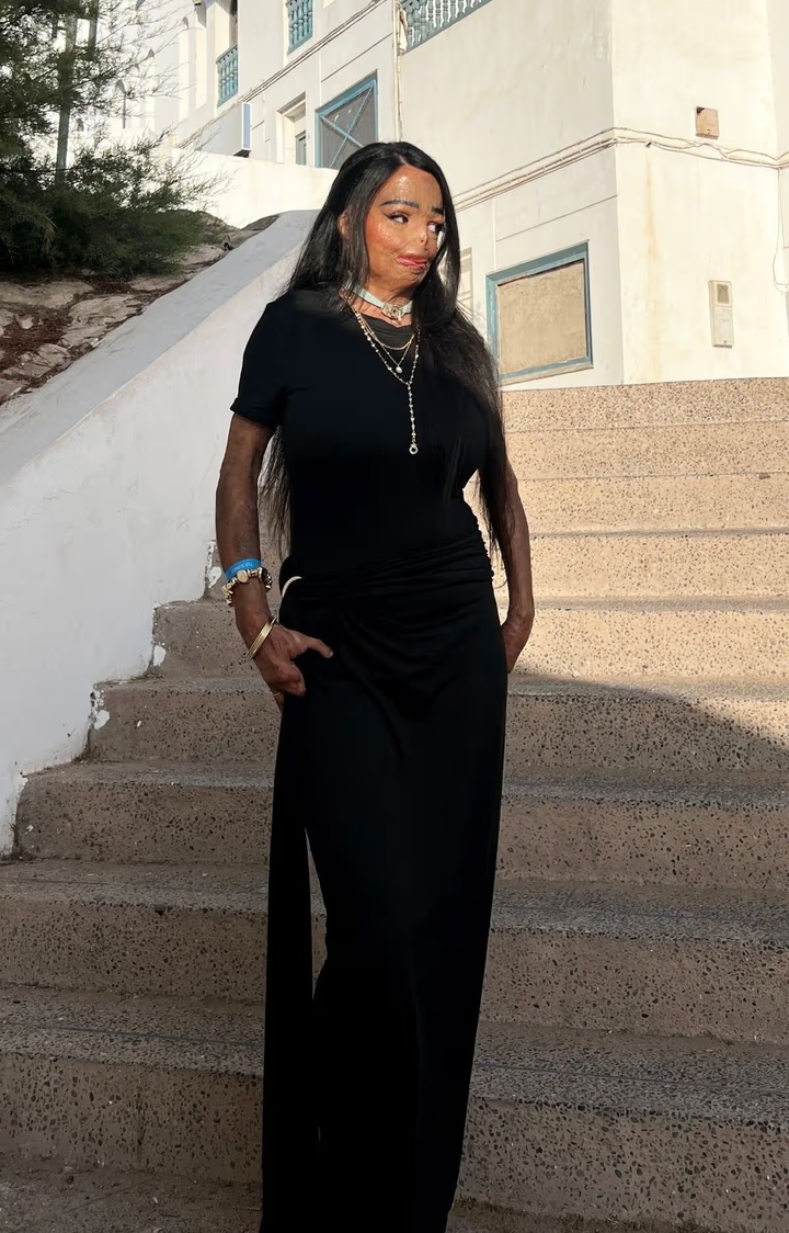 Dầu gội đầu bắt lửa, c&ocirc; g&aacute;i bị bỏng nửa người v&agrave; mất 7 ng&oacute;n tay- Ảnh 2.