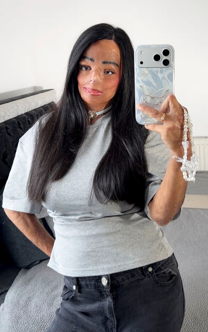 Dầu gội đầu bắt lửa, c&ocirc; g&aacute;i bị bỏng nửa người v&agrave; mất 7 ng&oacute;n tay- Ảnh 3.