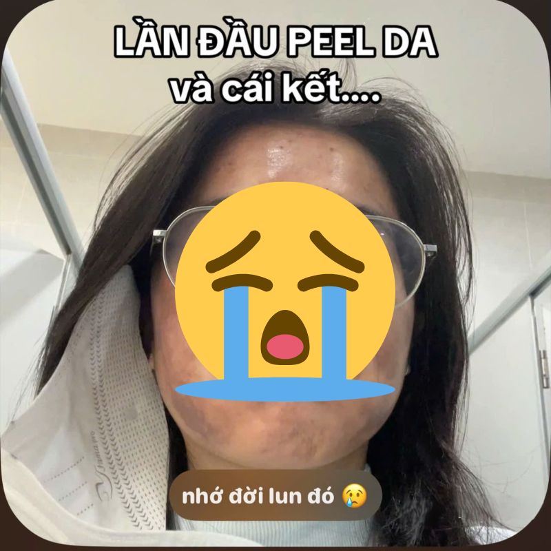 C&ocirc; g&aacute;i &ldquo;banh mặt&rdquo; khi peel da ở spa: Su&yacute;t mất Tết, tốn 10 lần tiền chữa nỗi đau- Ảnh 1.