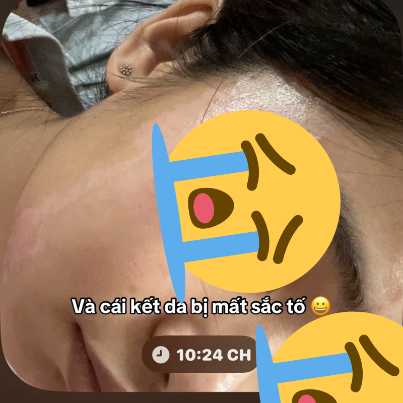 C&ocirc; g&aacute;i &ldquo;banh mặt&rdquo; khi peel da ở spa: Su&yacute;t mất Tết, tốn 10 lần tiền chữa nỗi đau- Ảnh 8.