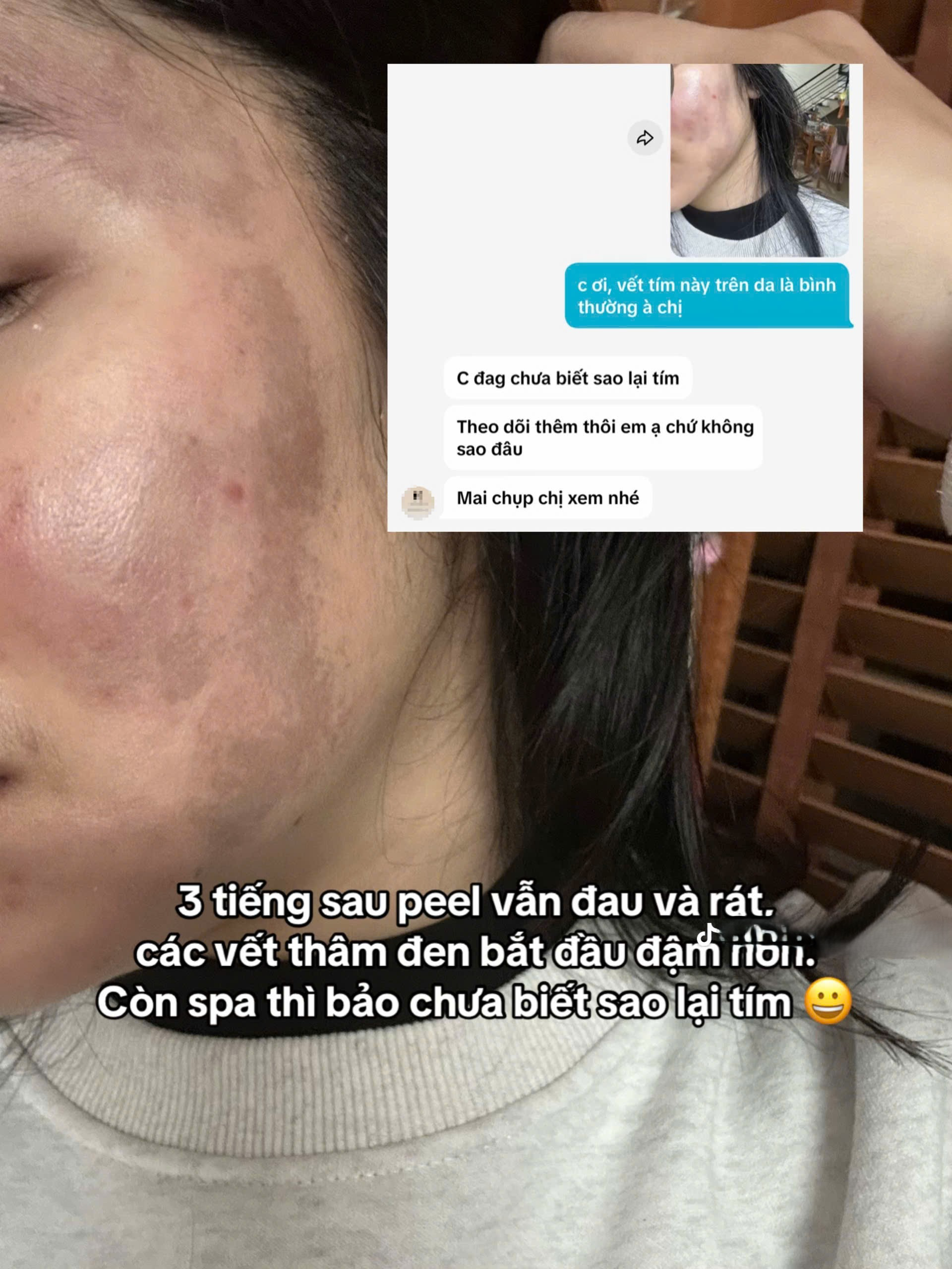 C&ocirc; g&aacute;i &ldquo;banh mặt&rdquo; khi peel da ở spa: Su&yacute;t mất Tết, tốn 10 lần tiền chữa nỗi đau- Ảnh 6.