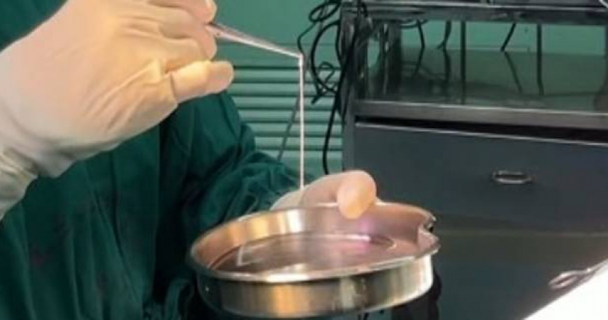 Người phụ nữ 32 tuổi đi ngo&agrave;i ra s&aacute;n d&agrave;i tới 3 m&eacute;t d&ugrave; chưa từng ăn đồ sống, b&aacute;c sĩ chỉ ra 1 thứ bếp nh&agrave; n&agrave;o cũng c&oacute; ch&iacute;nh l&agrave; thủ phạm- Ảnh 2.