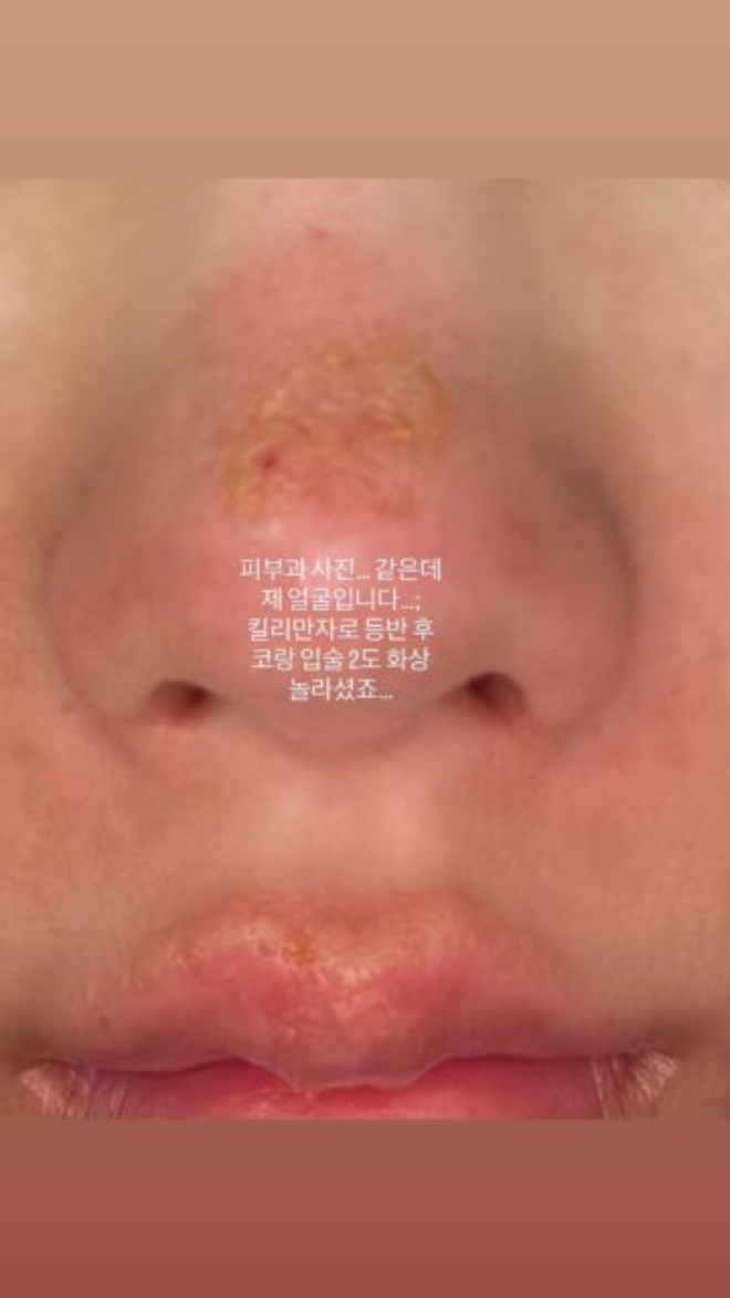 Nữ ho&agrave;ng gợi cảm showbiz bị bỏng mặt, x&oacute;t cho nhan sắc trời ban- Ảnh 2.