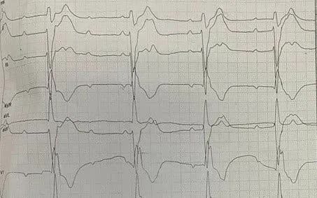 Tim đập hơn 200 nhịp/ph&uacute;t, huyết &aacute;p tụt s&acirc;u - người bệnh tho&aacute;t "cửa tử" nhờ cấp cứu kịp thời- Ảnh 1.