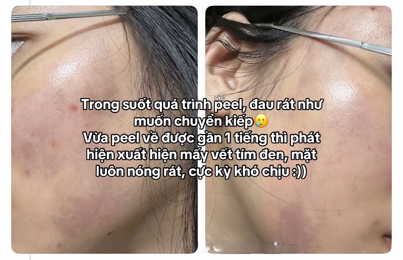 C&ocirc; g&aacute;i &ldquo;banh mặt&rdquo; khi peel da ở spa: Su&yacute;t mất Tết, tốn 10 lần tiền chữa nỗi đau- Ảnh 5.