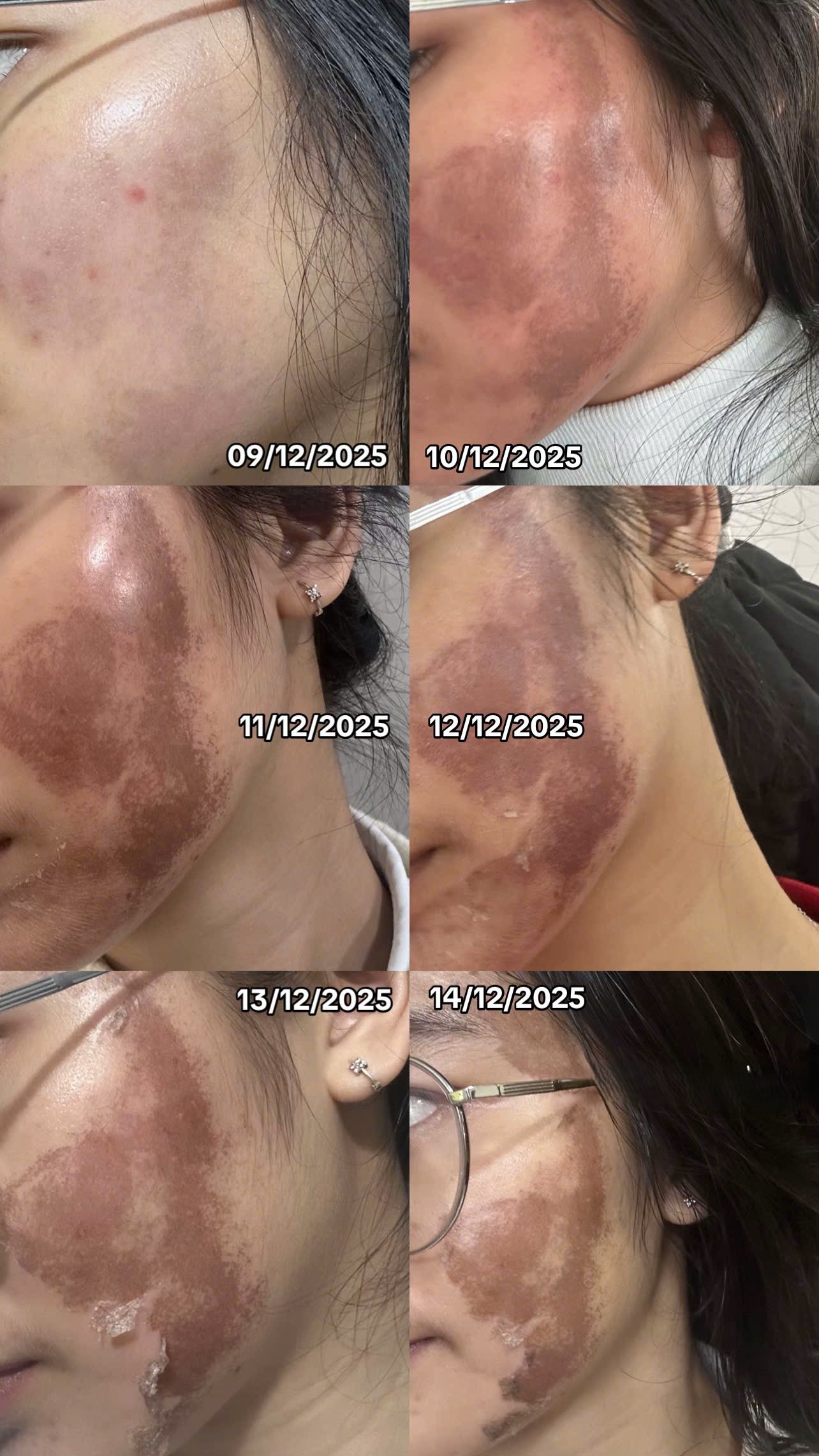 C&ocirc; g&aacute;i &ldquo;banh mặt&rdquo; khi peel da ở spa: Su&yacute;t mất Tết, tốn 10 lần tiền chữa nỗi đau- Ảnh 2.