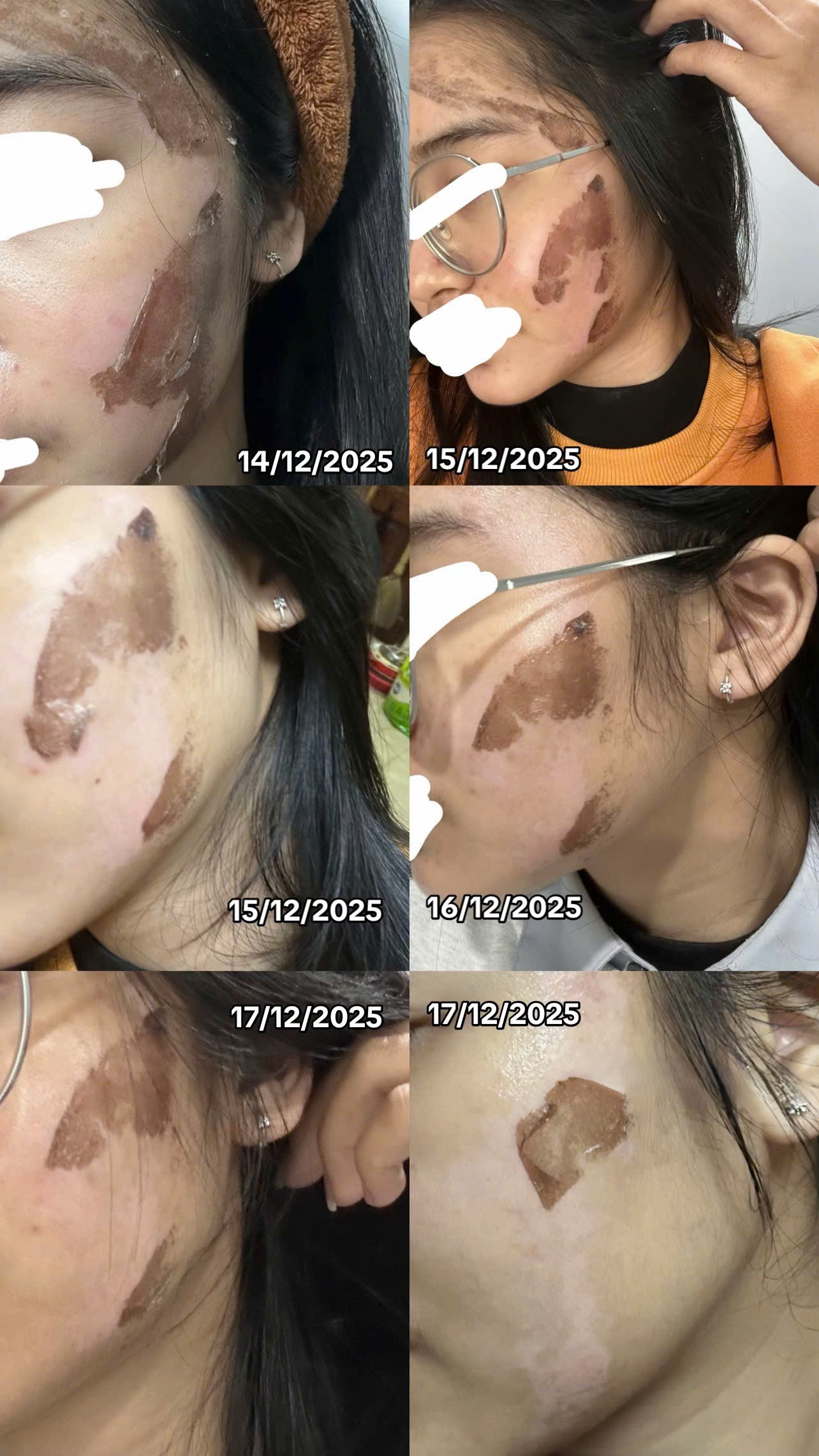 C&ocirc; g&aacute;i &ldquo;banh mặt&rdquo; khi peel da ở spa: Su&yacute;t mất Tết, tốn 10 lần tiền chữa nỗi đau- Ảnh 3.