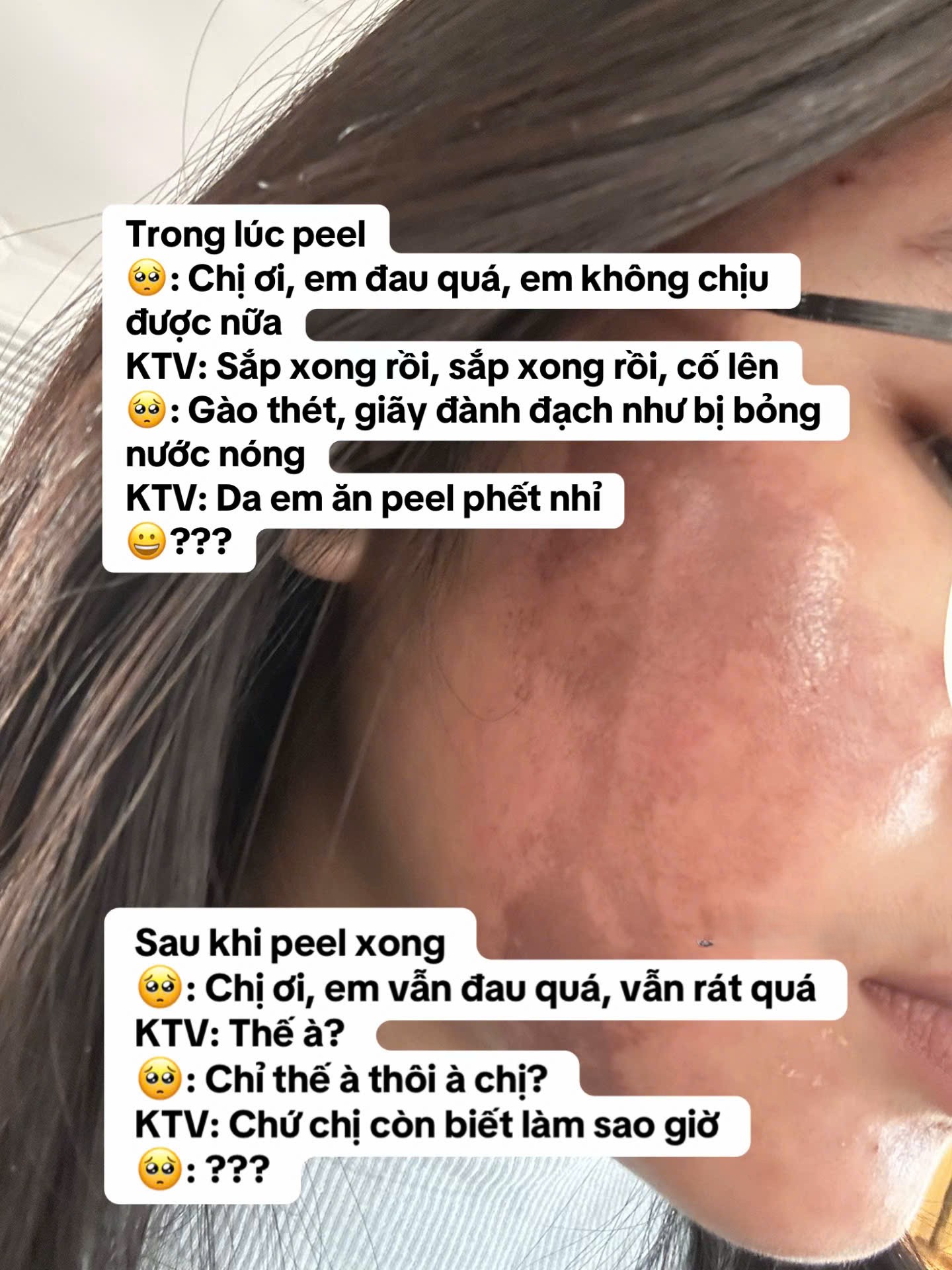 C&ocirc; g&aacute;i &ldquo;banh mặt&rdquo; khi peel da ở spa: Su&yacute;t mất Tết, tốn 10 lần tiền chữa nỗi đau- Ảnh 4.