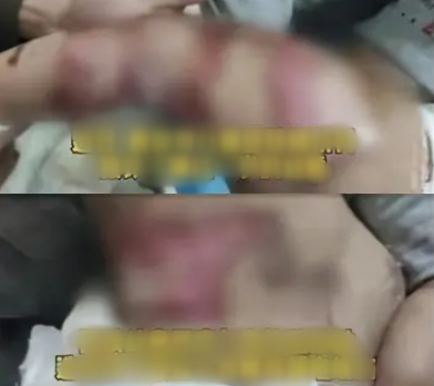 B&eacute; trai 1 tuổi bị bỏng nặng do 