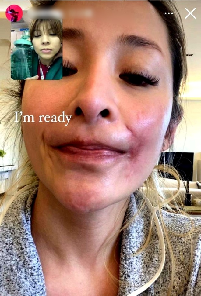 Nữ ca sĩ bị tai nạn đến hủy dung: Vết thương hoại tử 2 th&aacute;ng, giờ g&acirc;y sốc với 