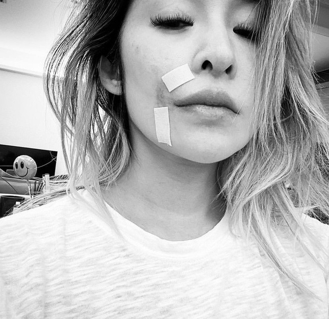 Nữ ca sĩ bị tai nạn đến hủy dung: Vết thương hoại tử 2 th&aacute;ng, giờ g&acirc;y sốc với 