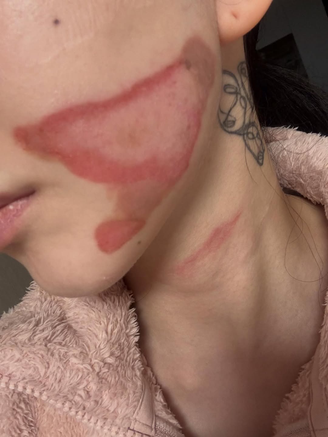 Nữ thần sắc đẹp showbiz bị bỏng mặt nghi&ecirc;m trọng hậu thẩm mỹ, nh&igrave;n t&igrave;nh h&igrave;nh hiện tại m&agrave; x&oacute;t thay- Ảnh 1.