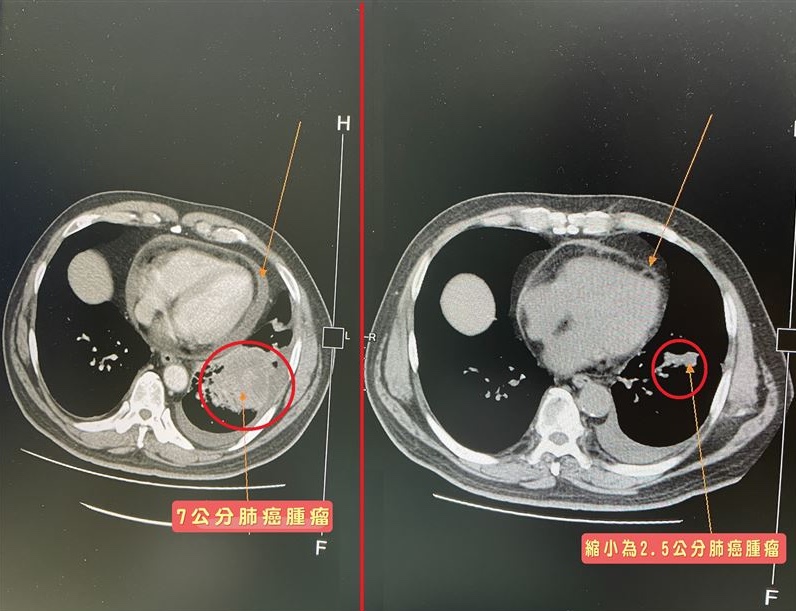 Nam t&agrave;i xế ph&aacute;t hiện ung thư phổi giai đoạn cuối nhờ 1 kh&oacute; chịu rất nhiều người tưởng "chuyện nhỏ" khi ngồi xe hơi- Ảnh 2.