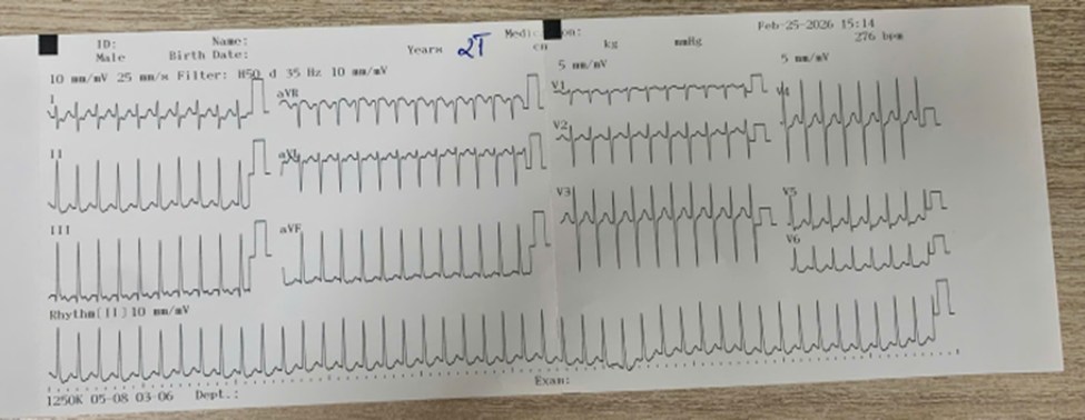 L&agrave;o Cai: B&eacute; 2 tuổi nhập viện v&igrave; nhịp tim hơn 285 lần/ph&uacute;t, b&aacute;c sĩ chỉ r&otilde; dấu hiệu bố mẹ cần đưa con đi kh&aacute;m ngay- Ảnh 1.