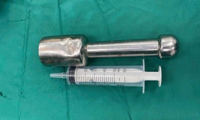 Chiếc ch&agrave;y 18 cm mắc kẹt trong trực tr&agrave;ng nam sinh 15 tuổi- Ảnh 1.