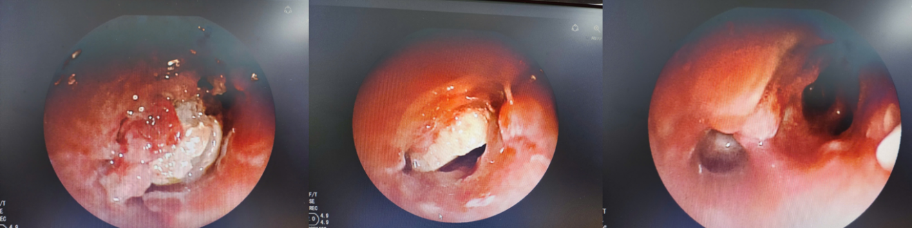 Thiếu ni&ecirc;n 15 tuổi h&oacute;c hạt hạnh nh&acirc;n trong phế quản 7 ng&agrave;y- Ảnh 1.