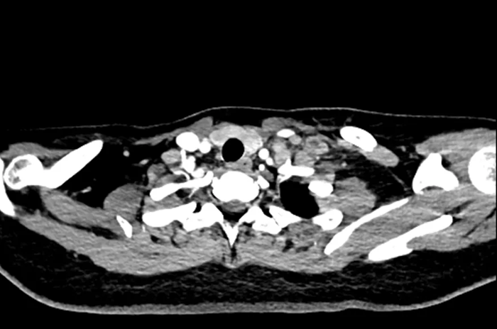 Nữ sinh 20 tuổi đau cổ, đi kh&aacute;m ph&aacute;t hiện ung thư dạ d&agrave;y đ&atilde; di căn to&agrave;n th&acirc;n: Đừng bỏ qua dấu hiệu n&agrave;y- Ảnh 1.