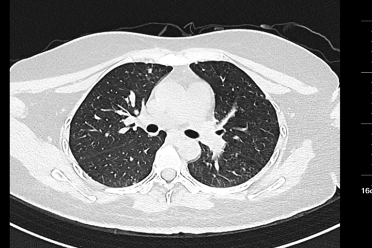 Nữ sinh 20 tuổi đau cổ, đi kh&aacute;m ph&aacute;t hiện ung thư dạ d&agrave;y đ&atilde; di căn to&agrave;n th&acirc;n: Đừng bỏ qua dấu hiệu n&agrave;y- Ảnh 2.
